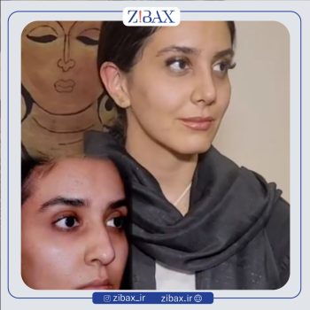 جراحی زیبایی بینی با دکتر وحید موحد