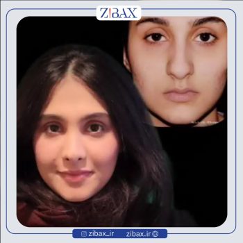 جراحی بینی گوشتی با دکتر وحید موحد