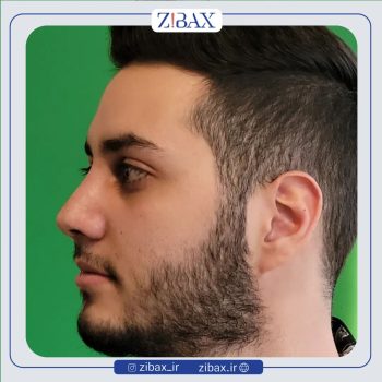 عمل بینی مردانه با دکتر وحید موحد