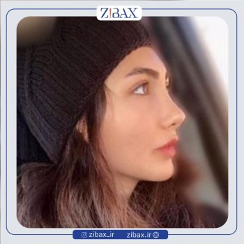 جراحی زیبایی بینی با دکتر پریسا قاسمی