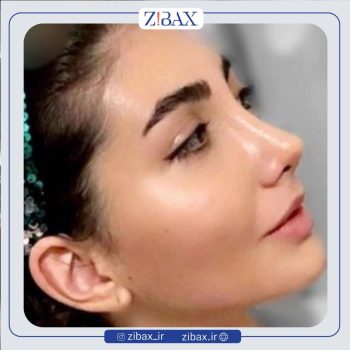 نمونه عمل طبیعی بینی با دکتر پریسا قاسمی