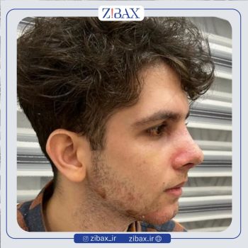 جراحی بینی آقایان با دکتر مهرداد جعفری