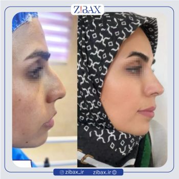 نمونه عمل بینی با دکتر فرشید شکوهی جراح بینی شیراز