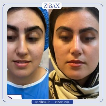 نمونه کار جراحی بینی با دکتر فرشید شکوهی جراح بینی شیراز