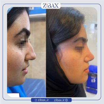 نمونه کار عمل بینی با دکتر فرشید شکوهی جراح بینی شیراز