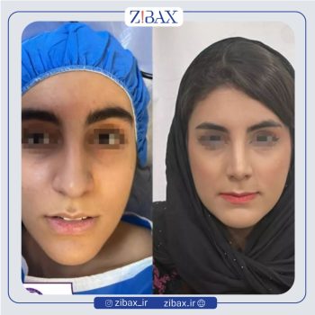 نمونه کار عمل بینی به سبک طبیعی با دکتر فرشید شکوهی جراح بینی شیراز