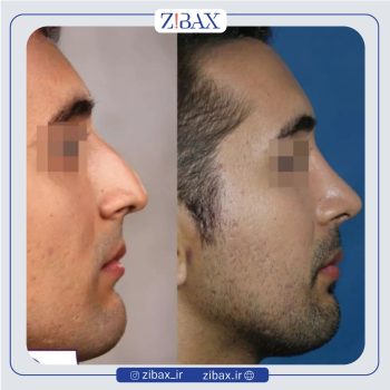 نمونه کار عمل بینی به سبک نیمه فانتزی با دکتر فرشید شکوهی جراح بینی شیراز