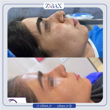 نمونه عمل بینی به سبک طبیعی با دکتر فرشید شکوهی جراح بینی شیراز