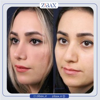 نمونه کار جراحی بینی با دکتر سعیدرضا توفیقی جراح بینی شیراز