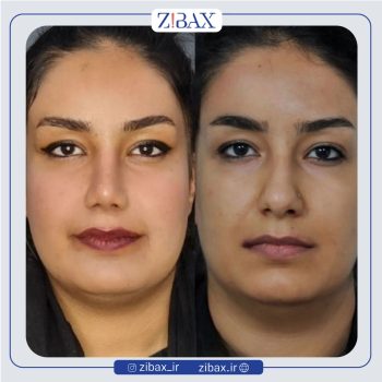 نمونه کار عمل بینی به سبک طبیعی با دکتر سعیدرضا توفیقی جراح بینی شیراز