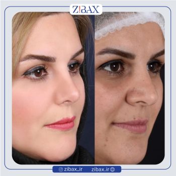 نمونه کار جراحی بینی به سبک طبیعی با دکتر سعیدرضا توفیقی جراح بینی شیراز