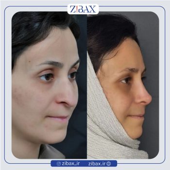 نمونه کار عمل بینی به سبک نیمه فانتزی با دکتر سعیدرضا توفیقی جراح بینی شیراز