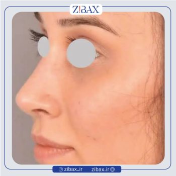 نمونه جراحی بینی با دکتر سیاوش معتضدیان جراح بینی شیراز