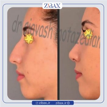 نمونه کار عمل بینی با دکتر سیاوش معتضدیان جراح بینی شیراز