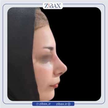 تصویر عمل زیبایی بینی با دکتر عطاالله غفاری در تهران