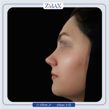 نمونه کار عمل زیبایی بینی دکتر عطاالله غفاری در تهران