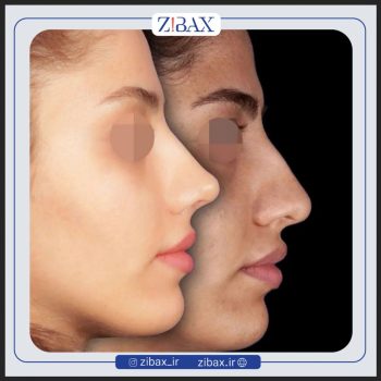 نمونه عمل بینی با دکتر محسن روشنی
