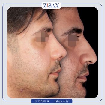 جراحی بینی مردانه با دکتر محسن روشنی
