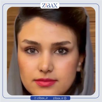 نمونه عمل بینی طبیعی با دکتر محسن روشنی