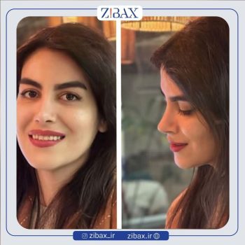 جراحی طبیعی بینی با دکتر مجتبی قائدی