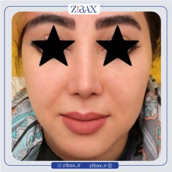 نمونه عمل زیبایی بینی دکتر مهدی احمدی تهران