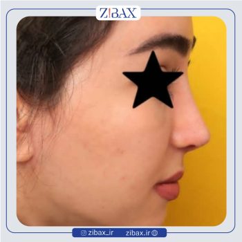 نمونه عمل دماغ به سبک طبیعی با دکتر مهدی احمدی جراح بینی تهران