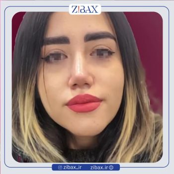 نمونه کار عمل زیبایی بینی با دکتر میعاد موسوی