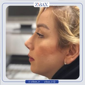 جراحی بینی با دکتر میعاد موسوی