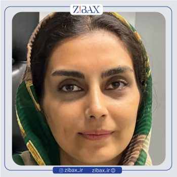 نمونه کار عمل بینی با دکتر امیر دریانی جراح بینی تهران