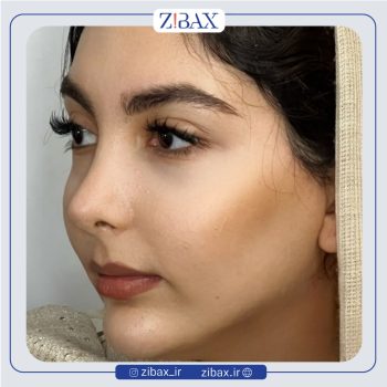 نمونه جراحی بینی با دکتر امیر دریانی جراح بینی تهران