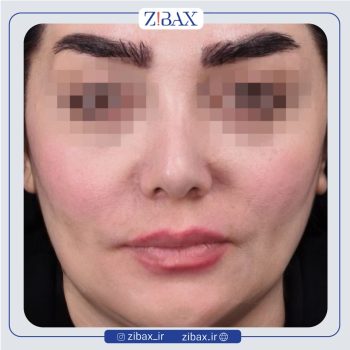 نمونه عمل بینی با دکتر امیر دریانی جراح بینی تهران