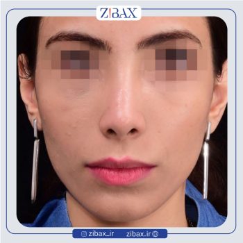 نمونه جراحی دماغ با دکتر امیر دریانی جراح بینی تهران