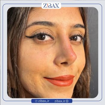 نمونه کار عمل بینی با دکتر نرگس میکانیکی