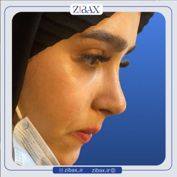 جراحی زیبایی بینی با دکتر نرگس میکانیکی