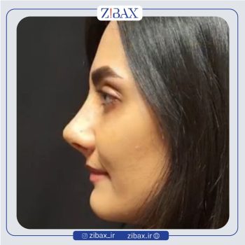 نمونه کار جراحی دماغ با دکتر وحیده درتاج جراح بینی تهران