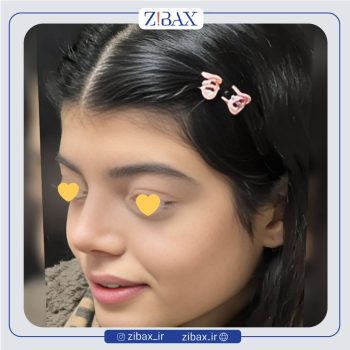 عکس جراحی زیبایی بینی توسط دکتر رضا چایچیان در تهران