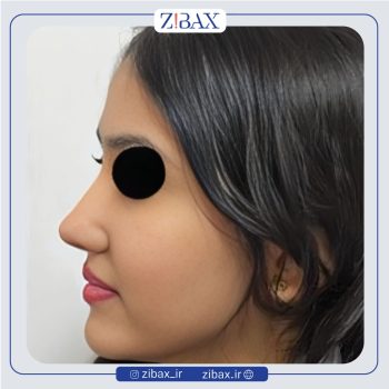 نمونه جراحی زیبایی بینی با دکتر رضا چایچیان جراح بینی تهران