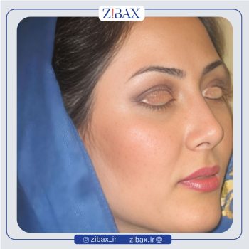 تصویر عمل زیبایی بینی با دکتر رضا چایچیان در تهران