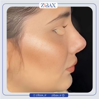 جراحی بینی با دکتر رضا چایچیان در تهران