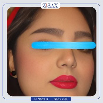 نمونه عمل زیبایی بینی دکتر رضا چایچیان تهران