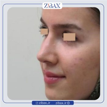 نمونه عمل بینی با دکتر سید ابوالحسن جزایری جراح بینی تهران