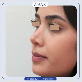 نمونه جراحی بینی با دکتر سید ابوالحسن جزایری جراح بینی تهران