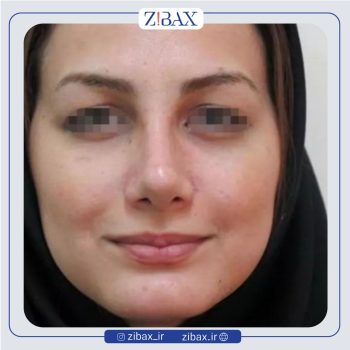 نمونه عمل بینی با دکتر سید ابوالحسن جزایری جراح بینی تهران