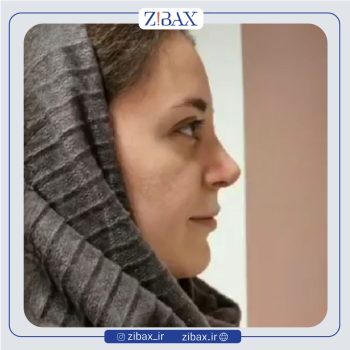 نمونه عمل بینی با دکتر مجید جلالی جراح بینی تهران