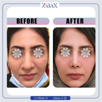 راینوپلاستی بینی با دکتر مینا جمالی