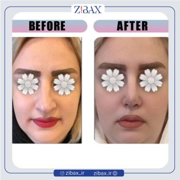 جراحی بینی با دکتر مینا جمالی