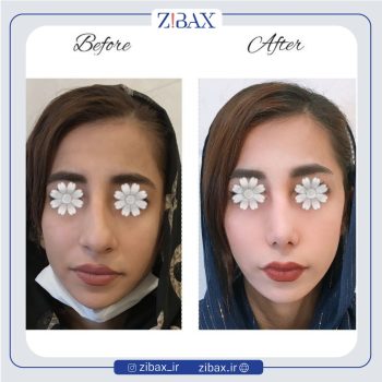 نمونه عمل بینی با دکتر مینا جمالی