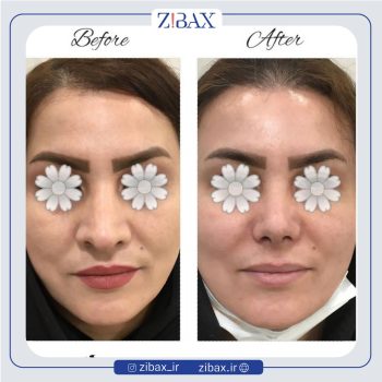 جراحی زیبایی بینی با دکتر مینا جمالی