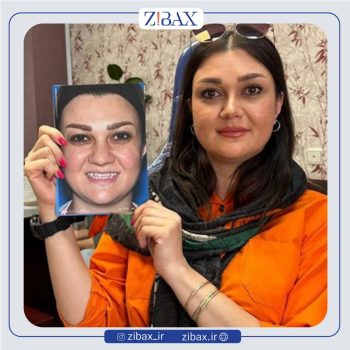 نمونه عمل بینی با دکتر بهرام بادامچی