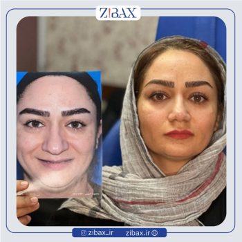 جراحی زیبایی بینی با دکتر بهرام بادامچی
